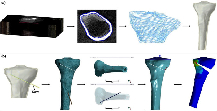 Evaluation of the effectiveness of Kirschner wires in preventing lateral hinge fractures in high tibial osteotomy: A finite element analysis.