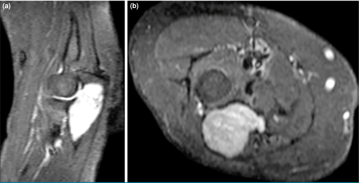 Intraosseous schwannoma of the olecranon: A case report.