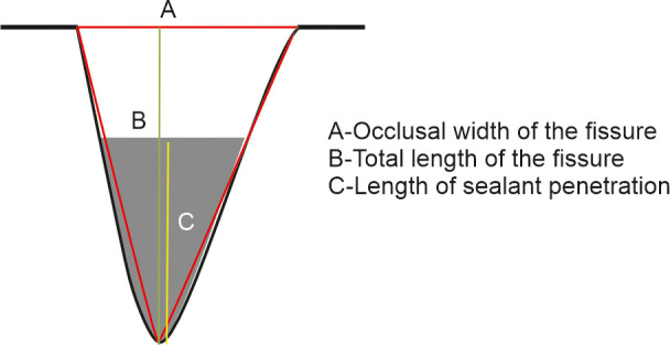 Efficacy of Ion-releasing Pit and Fissure Sealants Compared with Other Modified Pit and Fissure Sealants when Subjected to Heat and Ultrasonic Vibration: An <i>Ex Vivo</i> Comparison.