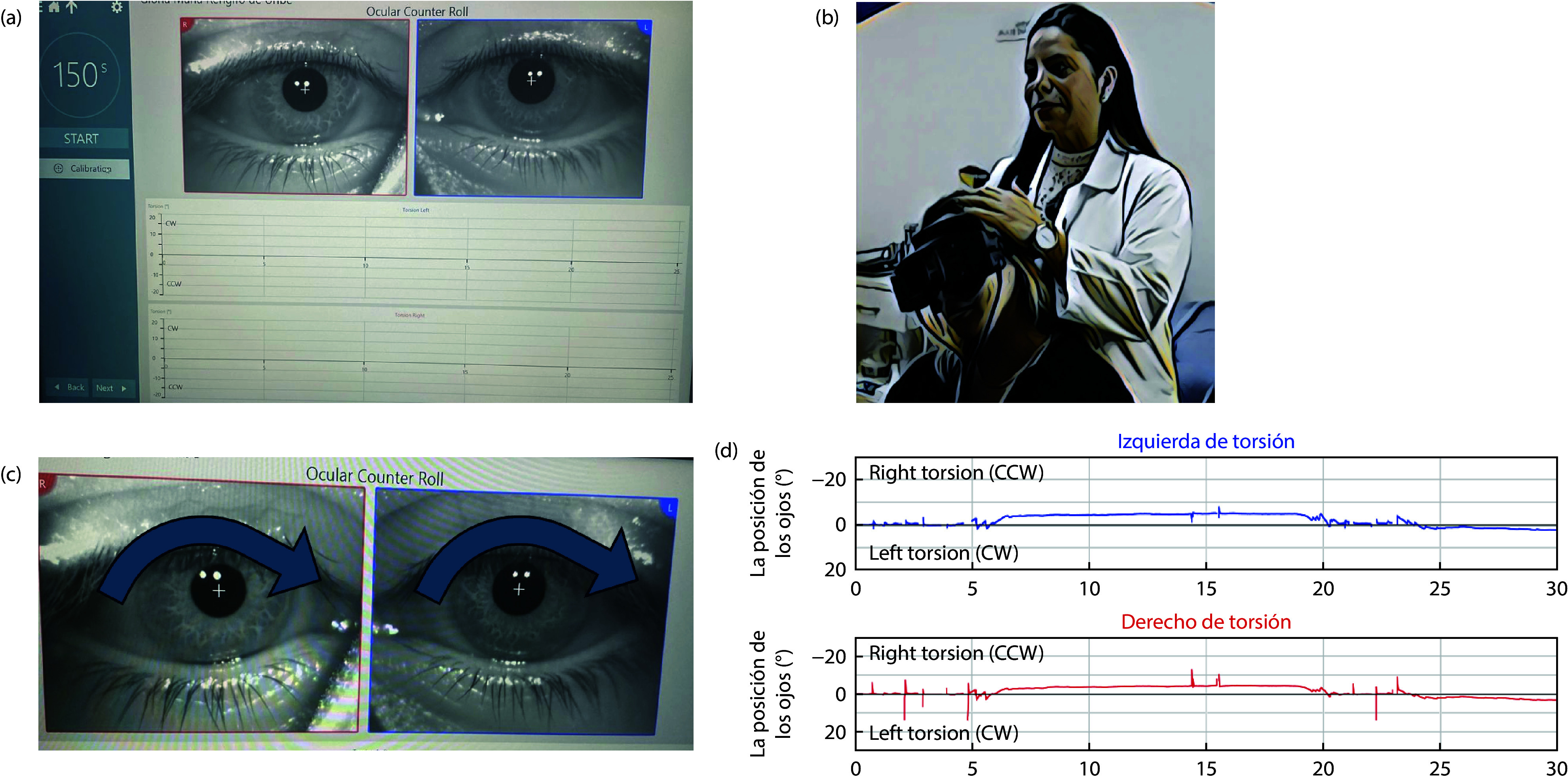 Otolith Degeneration with Aging: Insights from Video Ocular Counter-Roll (vOCR) Assessment.