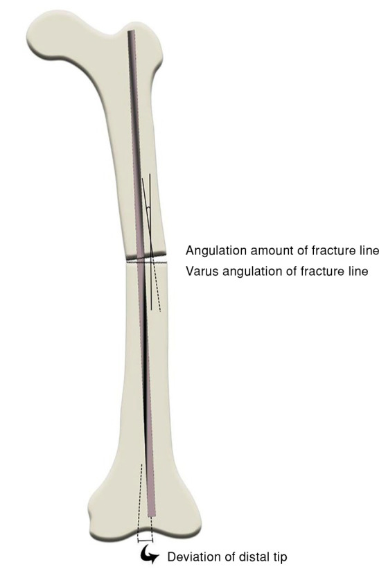 Evaluation of the effect of eccentric nailing on femoral diaphyseal union delay.