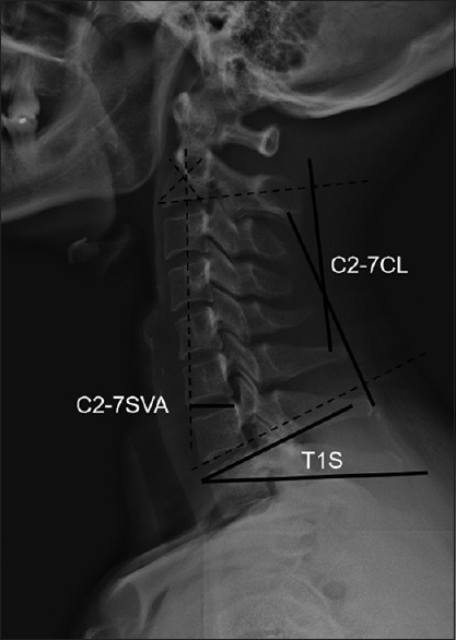 Impact of surgeries on normal match of T1 slope and cervical lordosis in cervical spondylotic myelopathy.