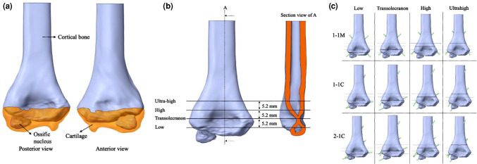 Effect of fracture level on optimal Kirschner wire configuration in pediatric supracondylar humerus fractures: A finite element analysis.