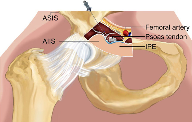 Ultrasound-guided pericapsular nerve group block and genicular nerve alcohol neurolysis in hip and knee pain due to osteoarthritis and following total joint replacement surgery: A preliminary study.