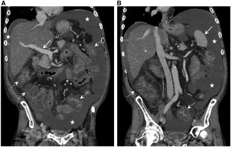 Florid ascites associated with alcohol use disorder without cirrhosis.