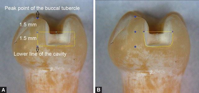 <i>In Vitro</i> Evaluation of Contact Tightness and Marginal Overhang in Class II Primary Molar Restorations Restored with Different Matrix Systems.