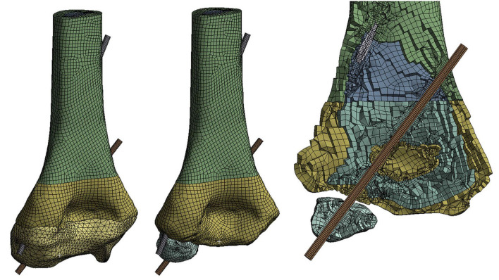 Effect of fracture level on optimal Kirschner wire configuration in pediatric supracondylar humerus fractures: A finite element analysis.