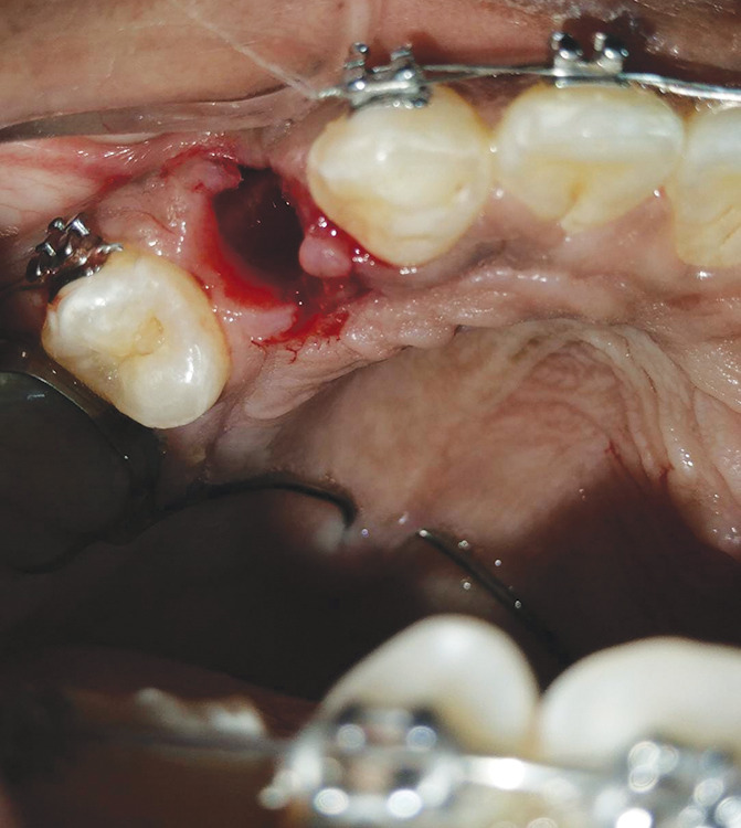 Evaluation of Efficacy of Advanced Platelet-rich Fibrin in Premolar Extraction Sockets as an Aid to Accelerate Orthodontic Tooth Movement and Wound Healing: A Split-mouth <i>In Vivo</i> Study.