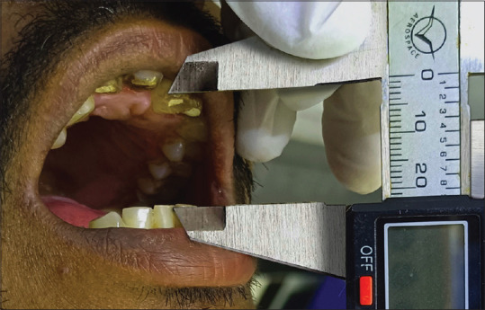 Evaluation of the effectiveness of oral Pirfenidone in the treatment of oral submucous fibrosis: A non-randomised pilot clinical trial.
