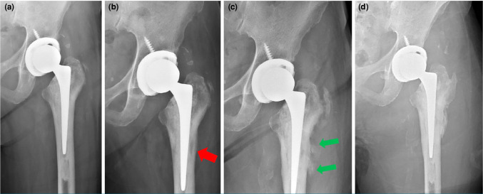 Eradication of Salmonella enteritidis periprosthetic hip infection using a custom-made articulating spacer: A case report.