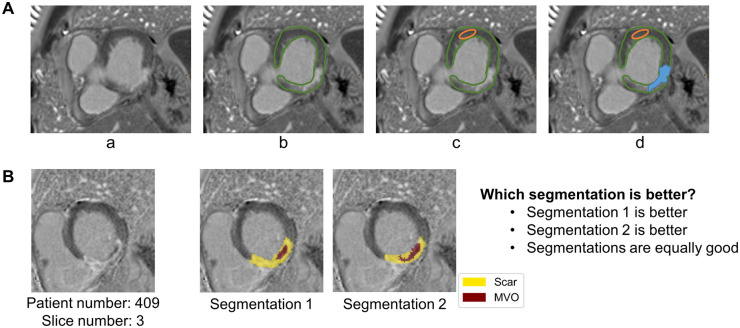 Deep learning pipeline for fully automated myocardial infarct segmentation from clinical cardiac MR scans.