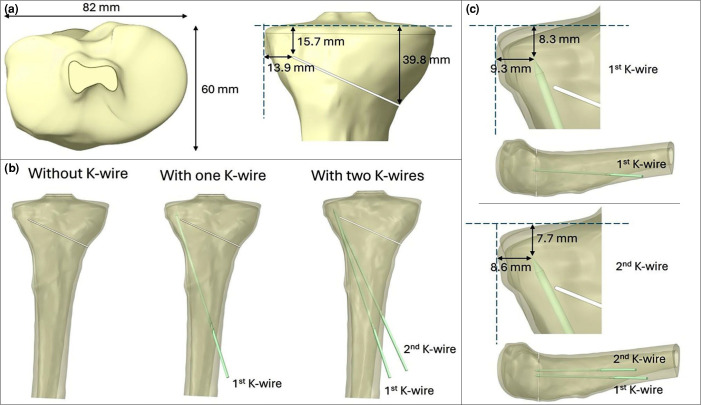 Evaluation of the effectiveness of Kirschner wires in preventing lateral hinge fractures in high tibial osteotomy: A finite element analysis.