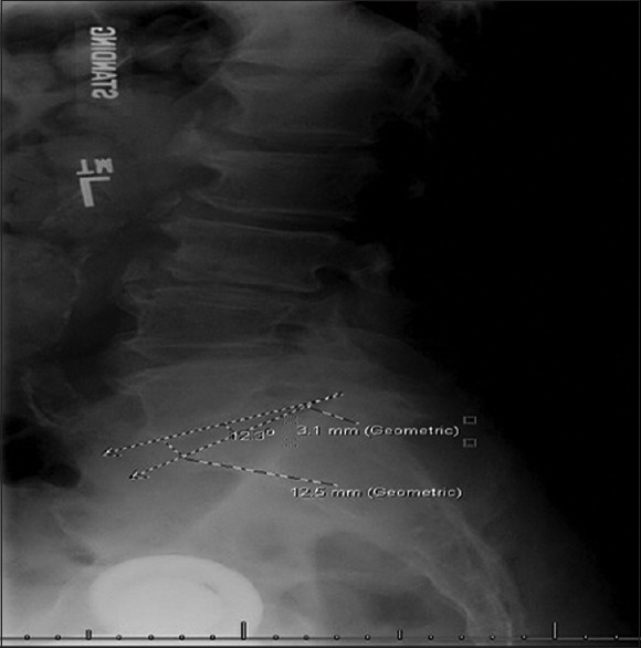 Lordotic restoration: A comparison of transforaminal lumbar interbody fusion expandable and static cages at the lumbosacral junction.