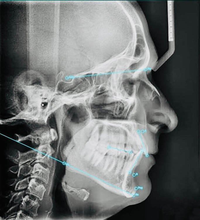 Comparative Evaluation of Digital and Manual Cephalometric Analysis in Mouth-breathing Patients: An <i>Ex Vivo</i> Study.