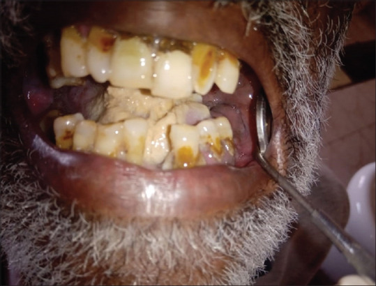 Emmprin (CD147) expression in oral submucous fibrosis and in oral squamous cell carcinoma-A potential predictor.