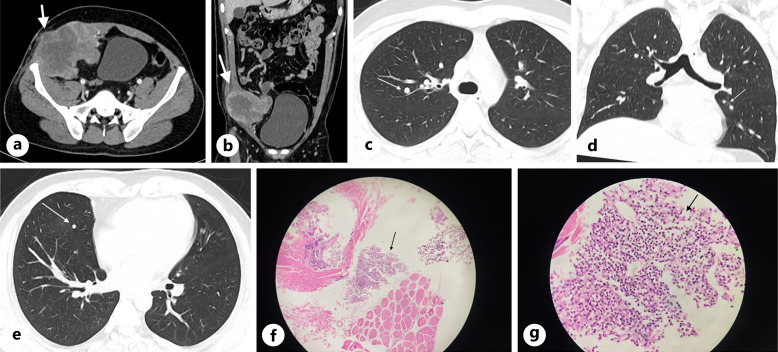 Rare Extraskeletal Ewing Sarcoma of the Anterior Abdominal Wall: A Diagnostic Challenge.
