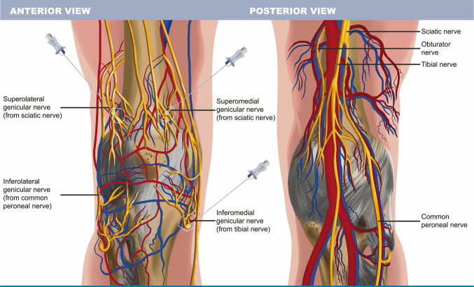 Ultrasound-guided pericapsular nerve group block and genicular nerve alcohol neurolysis in hip and knee pain due to osteoarthritis and following total joint replacement surgery: A preliminary study.