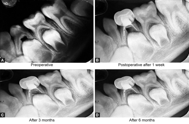 Comparative Clinical and Radiographic Evaluation of Three Different Herbal Extracts in Combination with Calcium Hydroxide as Obturating Materials in Primary Teeth: An <i>In Vivo</i> Study.