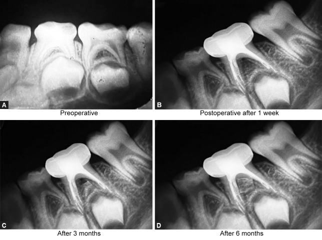 Comparative Clinical and Radiographic Evaluation of Three Different Herbal Extracts in Combination with Calcium Hydroxide as Obturating Materials in Primary Teeth: An <i>In Vivo</i> Study.