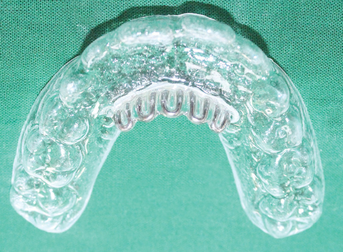 Tongue Retraining Appliance: Clear Tongue Crib and Clear Tongue Cage Appliance.