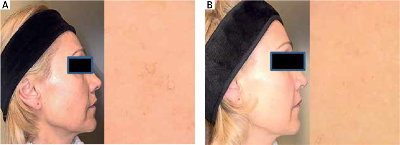 Effects of antioxidant-anti-inflammatory therapy on skin rejuvenation and repair. The clinical case series study.