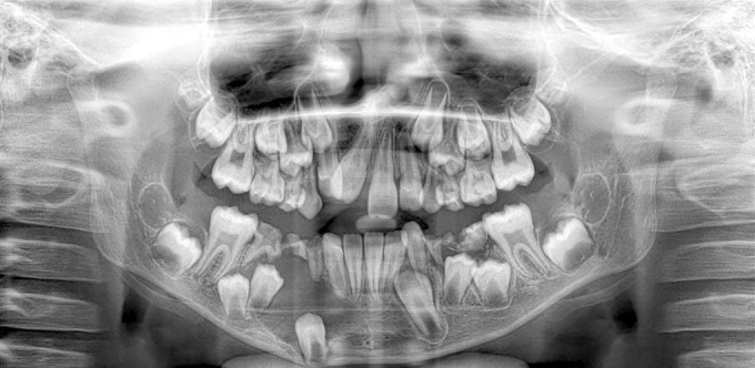 Pediatric Surgical Management of Cystic Ameloblastic Fibroma-Mural Type: A Rare Enigmatic Pathology.
