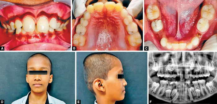 Familial, Nonsyndromic, Generalized Radiculomegaly Affecting Both Dentitions: The First Reported Case.