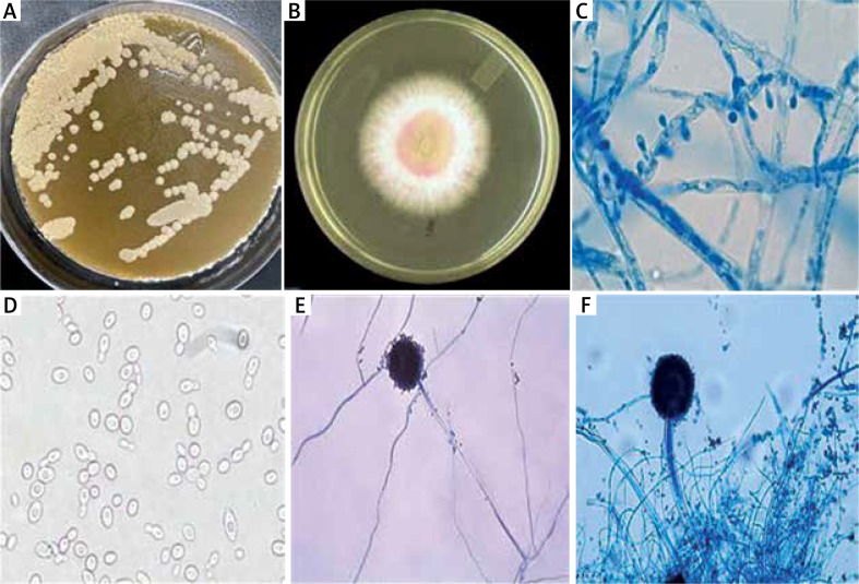 Association of skin microbiome with interleukin-23 in patients with plaque psoriasis.