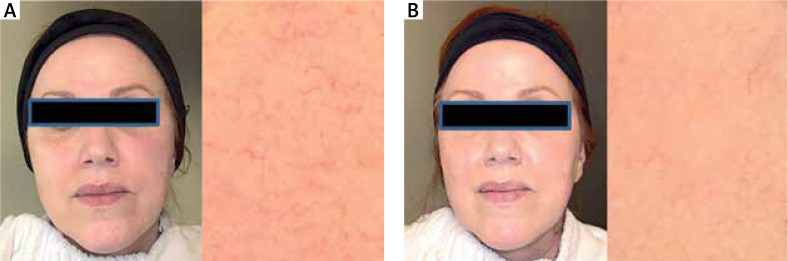 Effects of antioxidant-anti-inflammatory therapy on skin rejuvenation and repair. The clinical case series study.