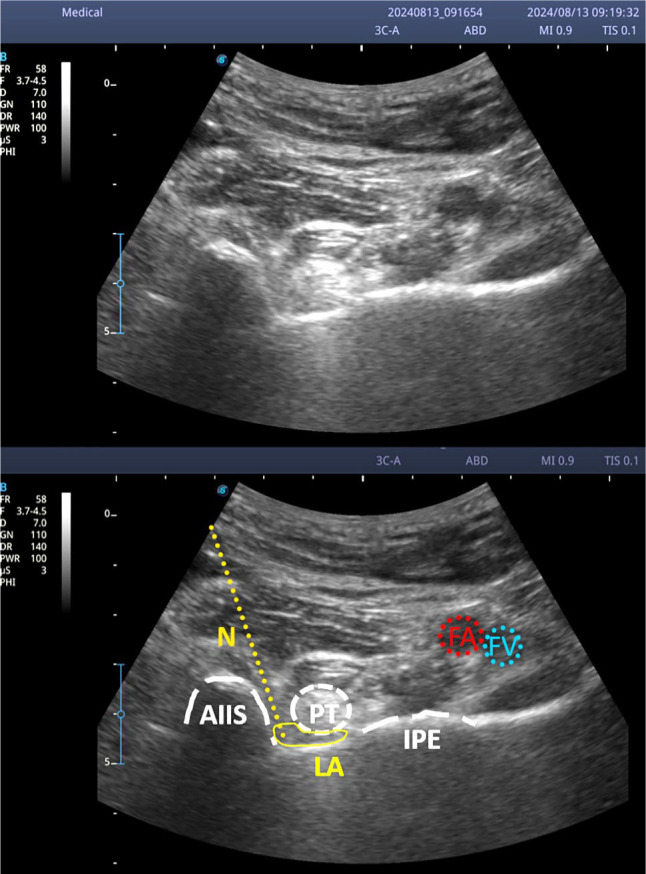Ultrasound-guided pericapsular nerve group block and genicular nerve alcohol neurolysis in hip and knee pain due to osteoarthritis and following total joint replacement surgery: A preliminary study.