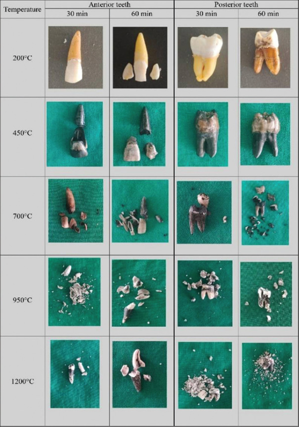 Forensic DNA analysis of heat-exposed unrestored teeth: Temperature and duration effects.