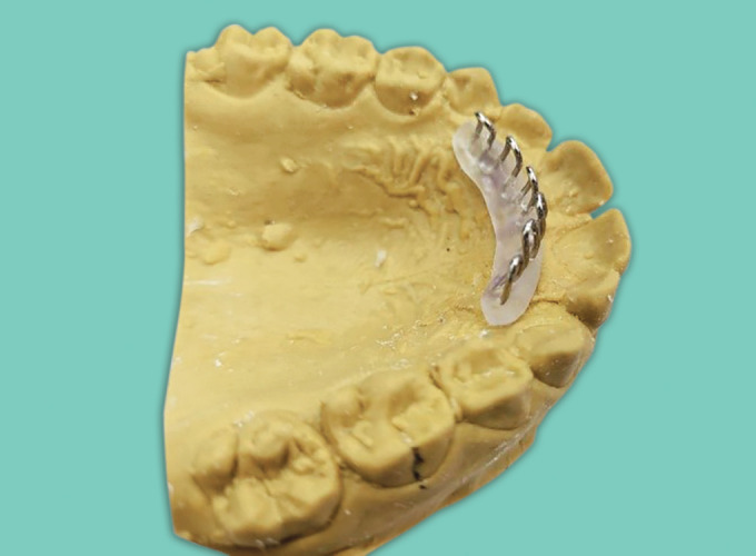 Tongue Retraining Appliance: Clear Tongue Crib and Clear Tongue Cage Appliance.