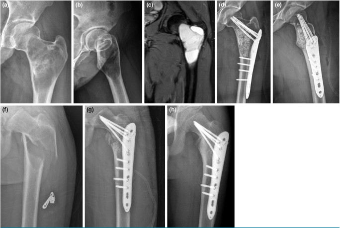 Impact of pathological fractures on kinesiophobia and anxiety in patients with benign and benign-aggressive lower extremity bone tumors.