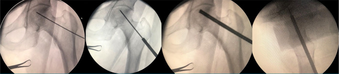 Clinical effectiveness of platelet rich fibrin combined with core decompression and grafting in early stage femoral head avascular necrosis.
