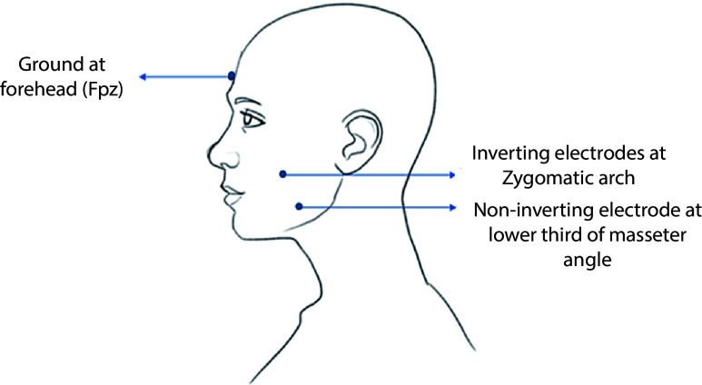 Masseter Vestibular Evoked Myogenic Potentials in Individuals with definite Meniere's Disease: An Exploratory Study.