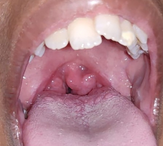 Correlation of Hypertrophic Adenoids and Tonsils with Craniofacial Growth, Occlusion, and Breathing Habit in 4-12-year-old Children.