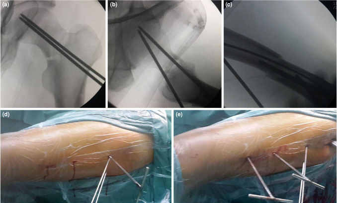 Percutaneous joystick reduction with reductor-T tape pin and fixation with a reconstruction nail for the treatment of ipsilateral femoral neck and shaft fractures.