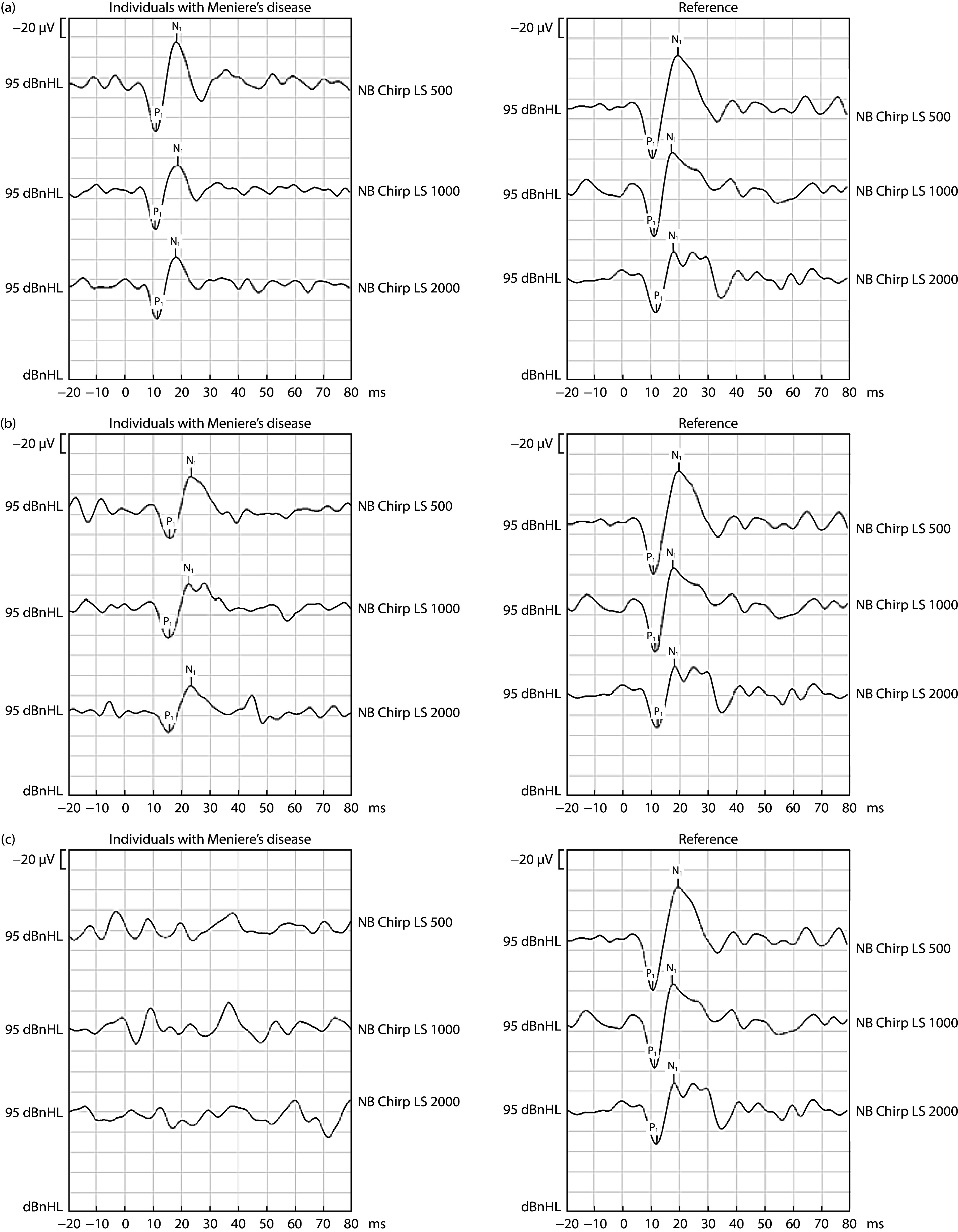 Masseter Vestibular Evoked Myogenic Potentials in Individuals with definite Meniere's Disease: An Exploratory Study.
