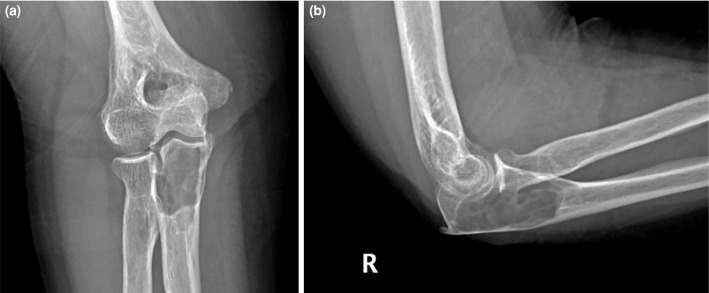 Intraosseous schwannoma of the olecranon: A case report.