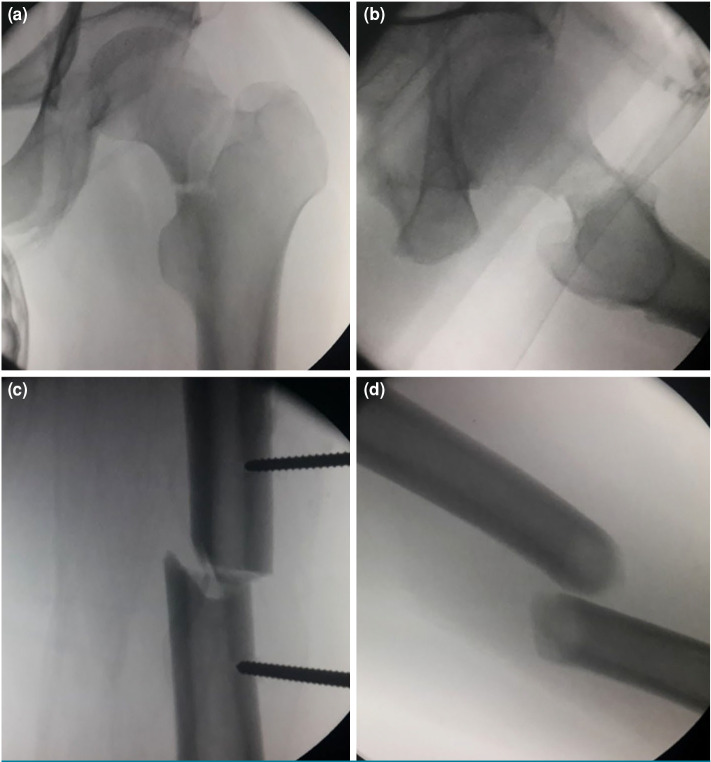 Percutaneous joystick reduction with reductor-T tape pin and fixation with a reconstruction nail for the treatment of ipsilateral femoral neck and shaft fractures.