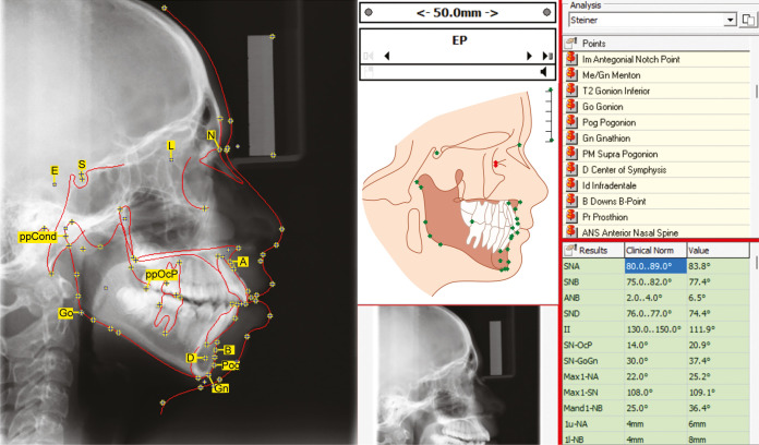 Comparative Evaluation of Digital and Manual Cephalometric Analysis in Mouth-breathing Patients: An <i>Ex Vivo</i> Study.