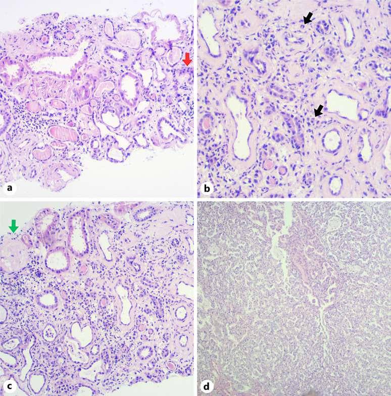 Acute Interstitial Nephritis Associated to Pertussis Infection: A Case Report and Review of the Literature.