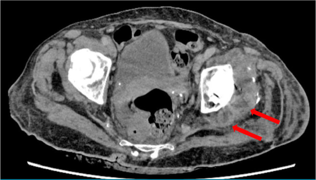 Eradication of Salmonella enteritidis periprosthetic hip infection using a custom-made articulating spacer: A case report.