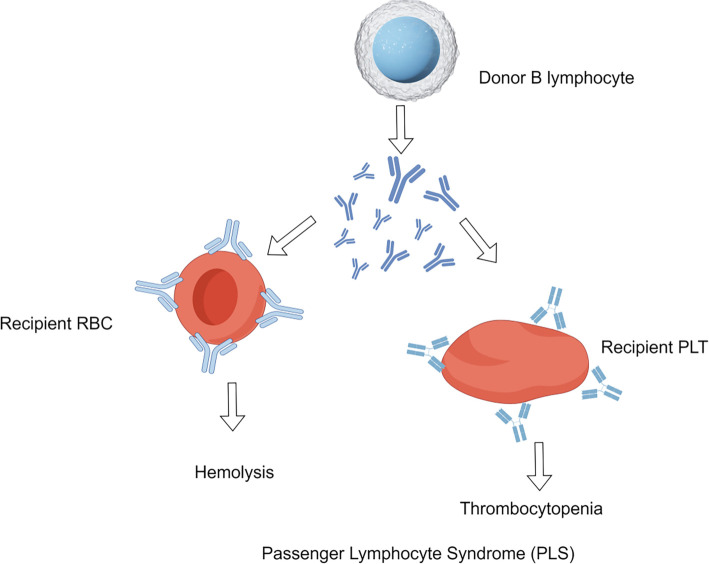 Passenger lymphocyte syndrome - Epidemiology, pathogenesis, diagnosis, treatment and future directions: A review.