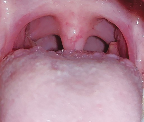Correlation of Hypertrophic Adenoids and Tonsils with Craniofacial Growth, Occlusion, and Breathing Habit in 4-12-year-old Children.
