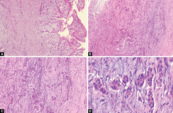 Pediatric Surgical Management of Cystic Ameloblastic Fibroma-Mural Type: A Rare Enigmatic Pathology.