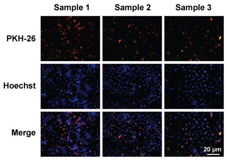 Protective mechanisms of exosomes derived from human umbilical cord mesenchymal stem cells in bronchopulmonary dysplasia.