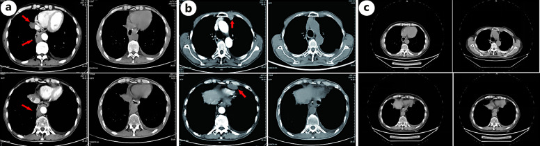 Recurrent and Metastatic Small Cell Carcinoma of the Esophagus in Which Long-Term Survival Was Achieved by Abscopal Effect of Radiotherapy: A Case Report.