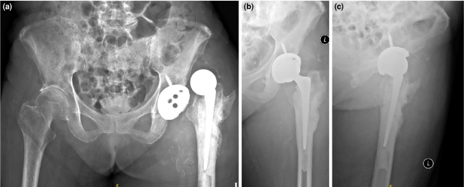 Eradication of Salmonella enteritidis periprosthetic hip infection using a custom-made articulating spacer: A case report.