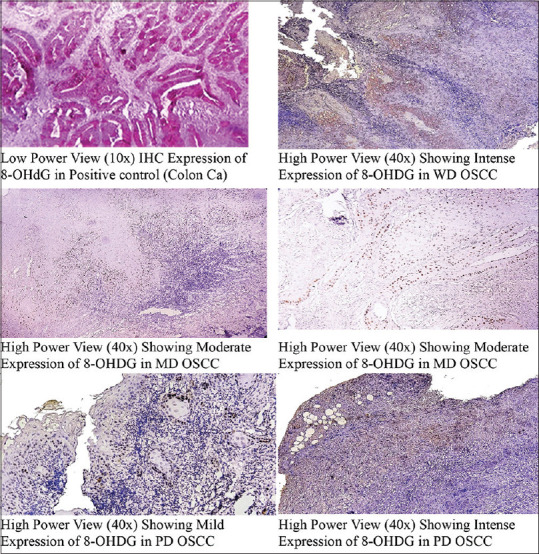 Evaluation of the immunohistochemical expression of oxidative DNA damage marker 8-OHdG in oral cancer.